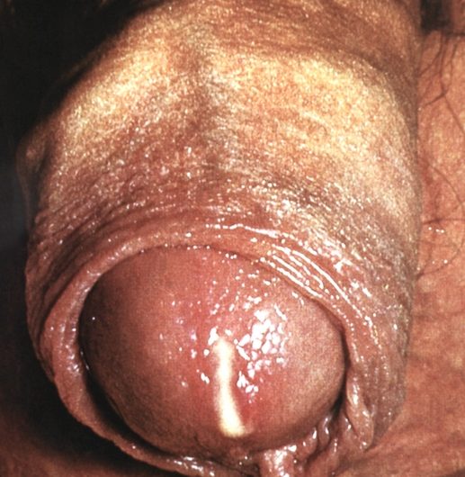 مرض السيلان: Gonorrhea