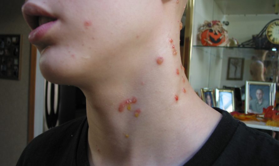 المليساء المعدية – Molluscum Contagiosum